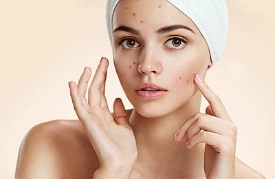 10 самых эффективных мазей от прыщей
