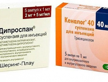 Лучший глюкокортикостероид – Кеналог или Дипроспан?